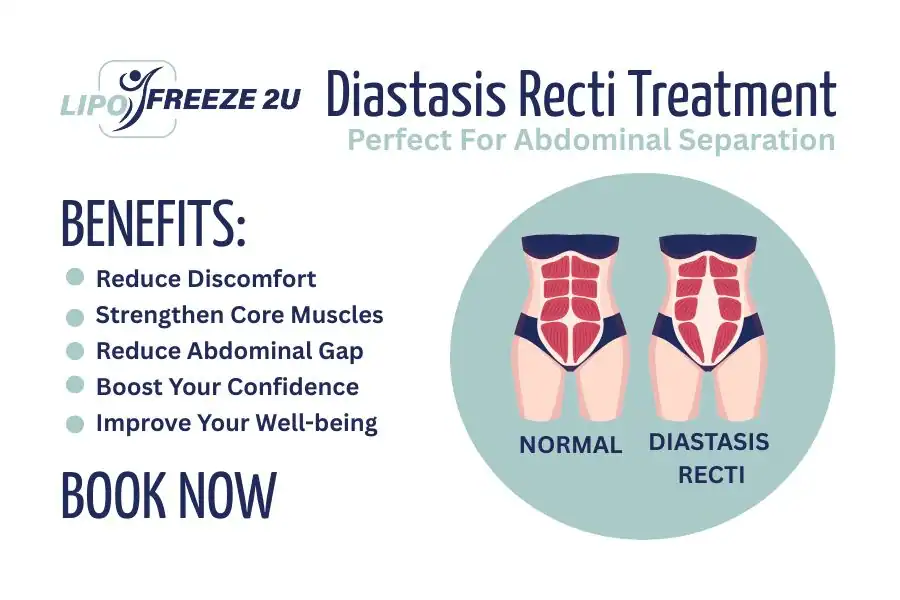 How Long Will It Take to See Improvements in Diastasis Recti Finchley