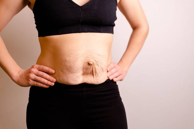 Is Surgery Really the Only Way to Repair Diastasis Recti Finchley?