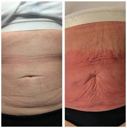 How Does RF Microneedling Improve Crepey, Thin and Uneven Skin Texture Finchley?