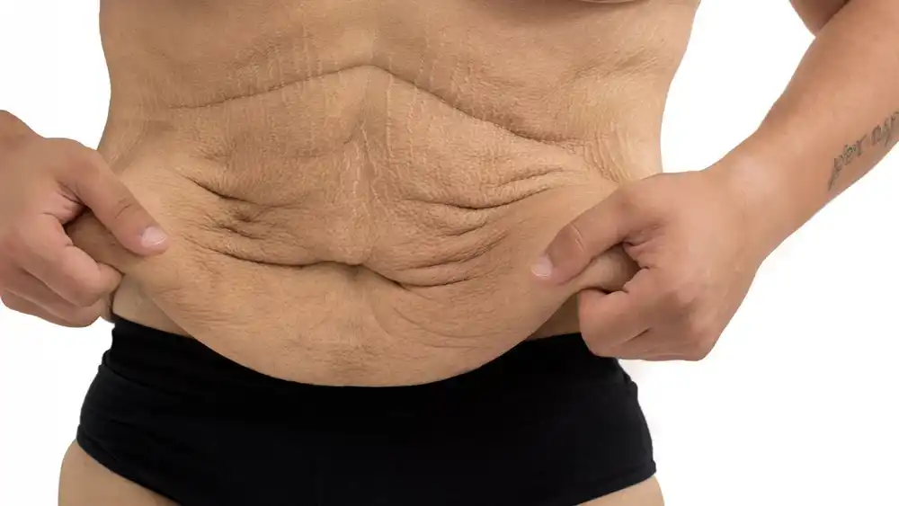 RF Microneedling for Loose Skin: How Can It Help Tighten and Reshape the Skin Finchley?